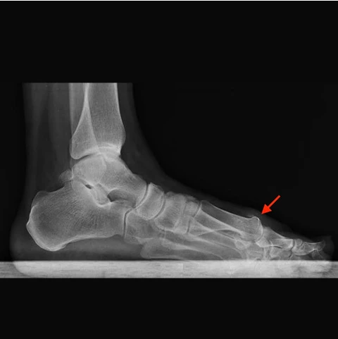 Hallux Rigidus et Limitus